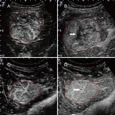 Machine Learning-Based Ultrasomics Improves the Diagnostic Performance in Differentiating Focal Nodular Hyperplasia and Atypical Hepatocellular Carcinoma